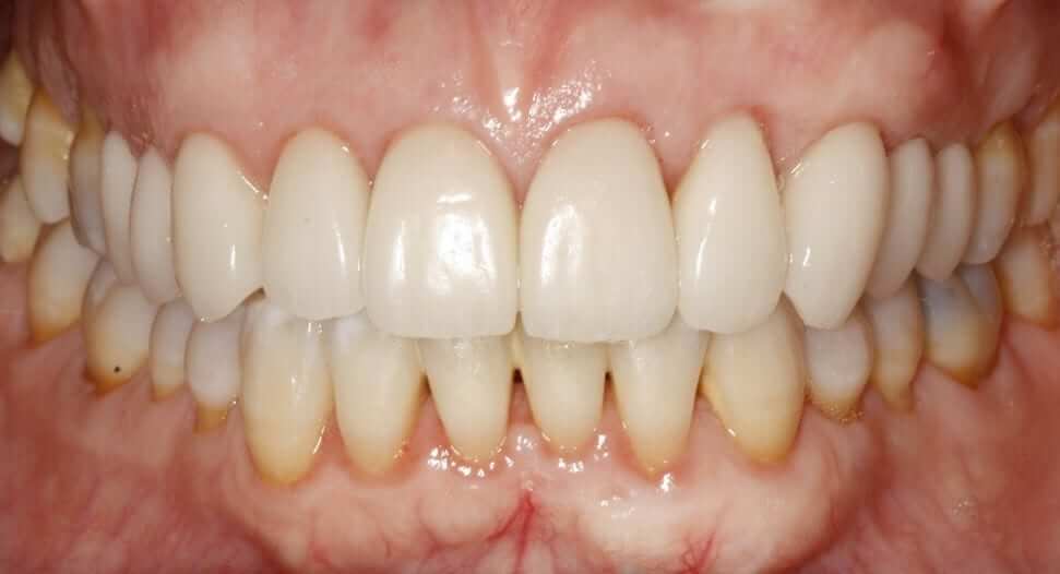 Caso médico carillas dentales después