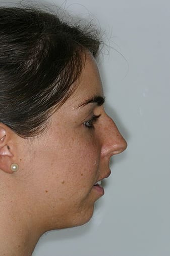 Antes del tratamiento de sonrisa gingival Antes del tratamiento de sonrisa gingival