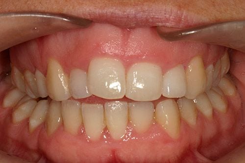 Antes sonrisa gingival Antes sonrisa gingival
