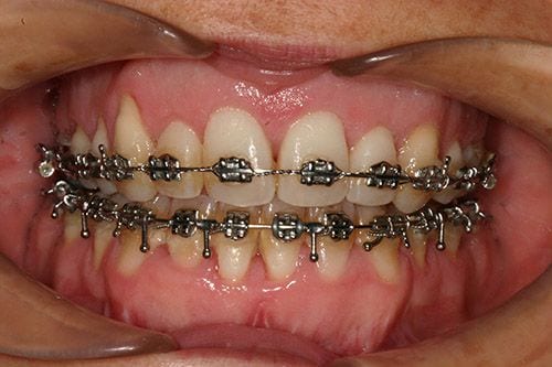 Despues sonrisa gingival Despues sonrisa gingival