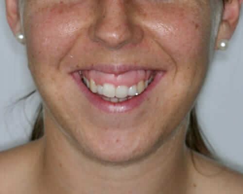 somriure gingival 2 abans