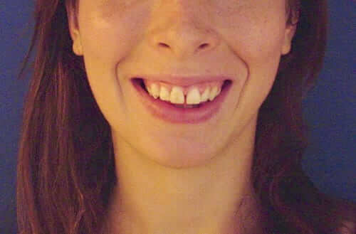 somriure gingival antes somriure gingival antes