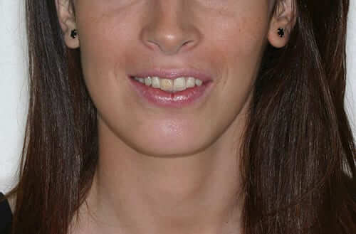 somriure gingival despues somriure gingival despues