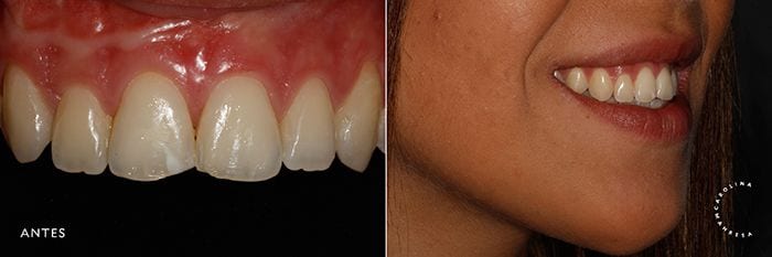 Carillas de porcelana antes carillas de porcelana antes