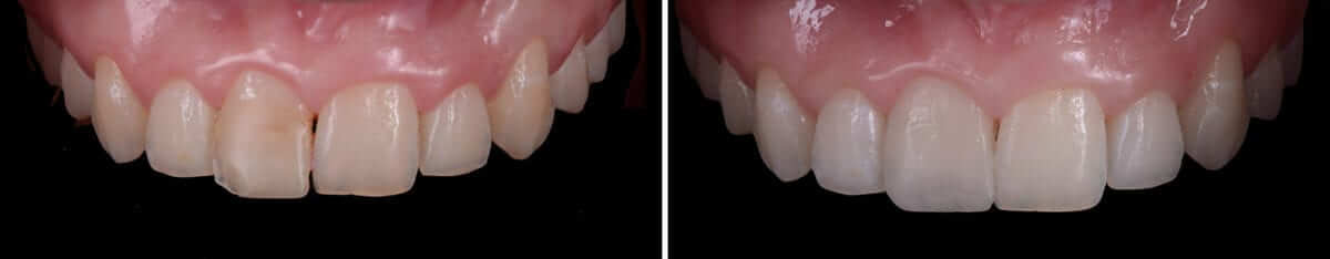 Composite resultados Composite resultados
