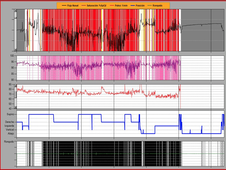 informa apnea 2
