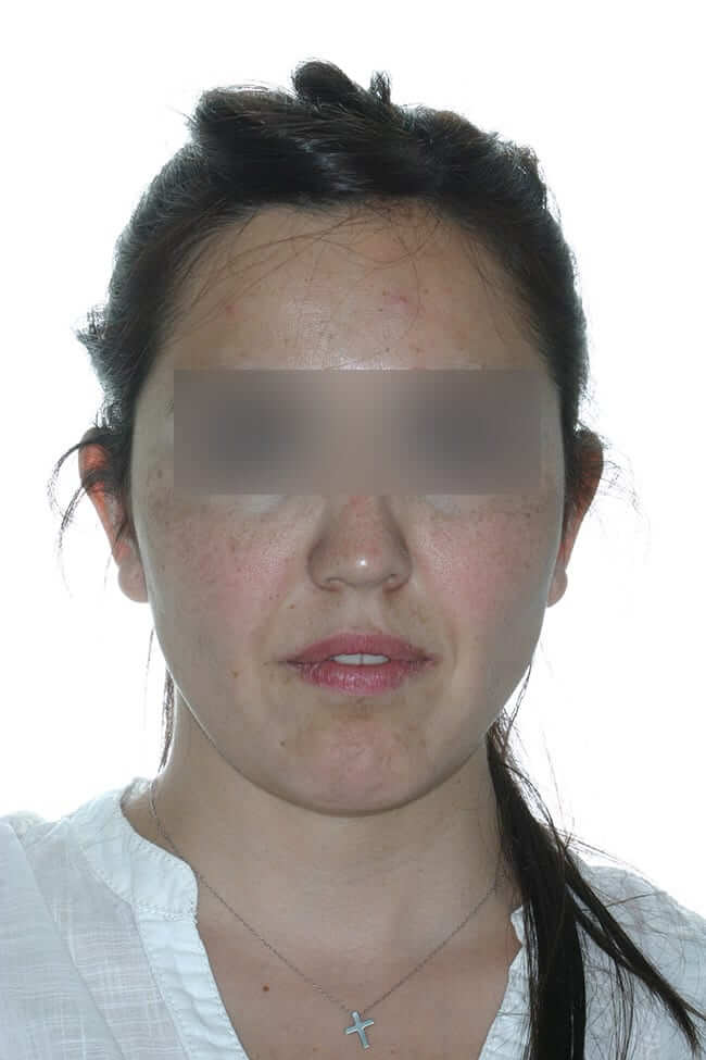 Lífting facial