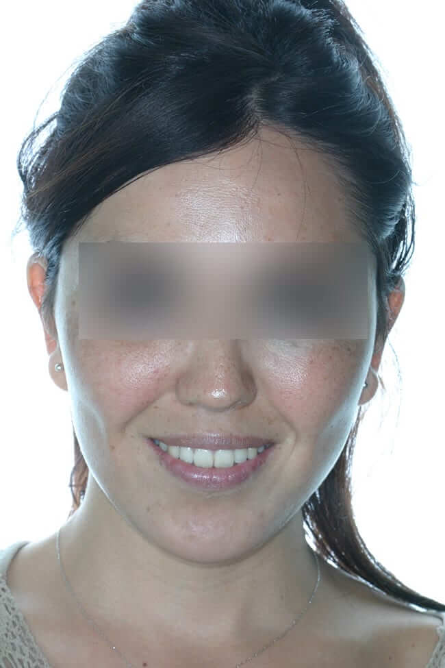 Lífting facial