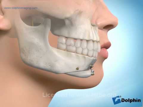 mentoplastia Alteraciones mentón