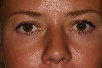 Despues Blefaroplastia inferior Despues Blefaroplastia inferior