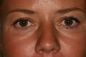 Antes Blefaroplastia inferior Antes Blefaroplastia inferior