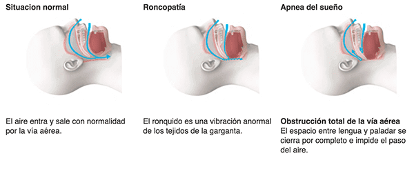 tratamiento apnea