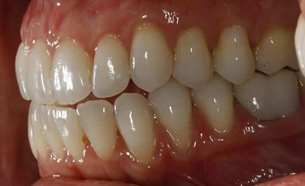 After left periodoncia After left periodoncia