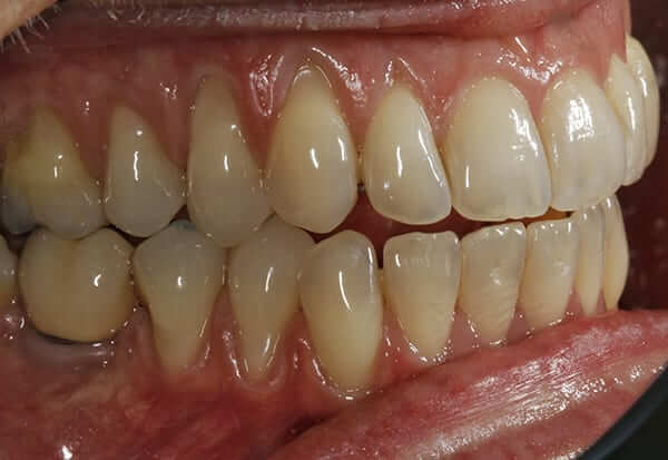 Before left periodoncia Before left periodoncia
