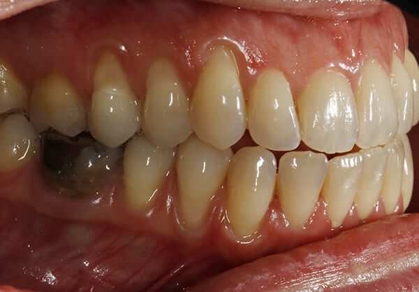Before right periodoncia Before right periodoncia