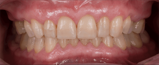 Desgaste dental despues Desgaste dental despues