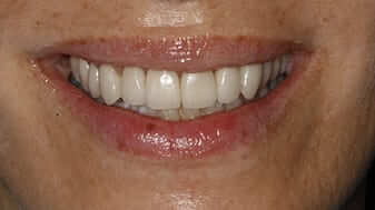 caso-medico-carillas-dentales-despues-sonr