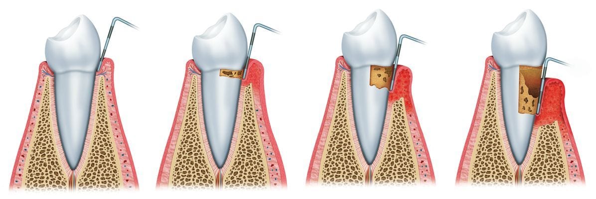Proceso periodoncia