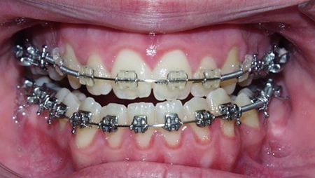 antes-prognatismo-mandibular Antes Prognatismo Mandibular