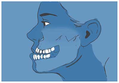 prognatismo Operación prognatismo mandibular
