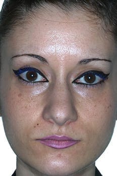 Caso rinoplastia