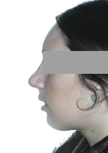 Resultados rinoplastia Caso rinoplastia
