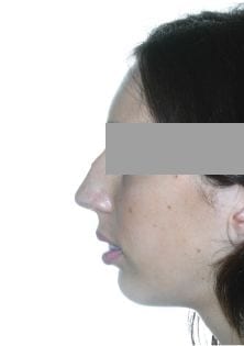 caso-rinoplastia Caso rinoplastia