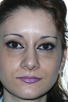 Caso rinoplastia