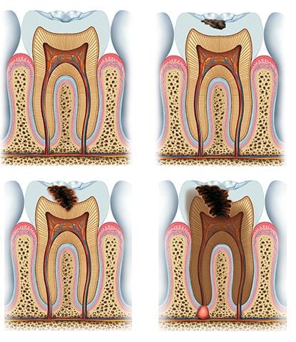 Origen caries Origen caries