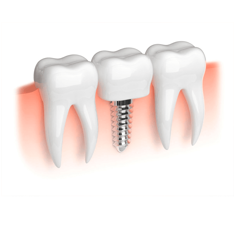 Razones para colocarse implantes dentales