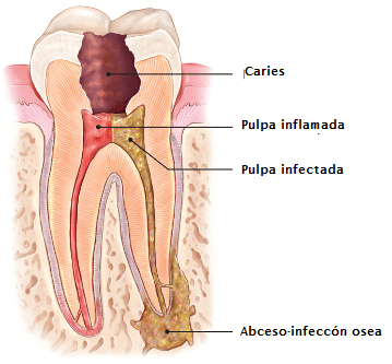 endodoncia barcelona endodoncia barcelona