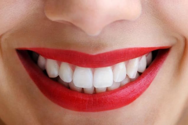Carillas dentales