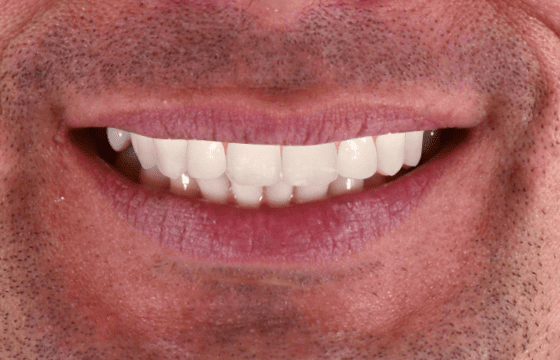 Smile Design