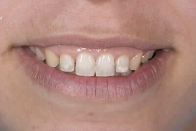 Smile Design