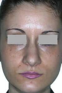 antes-rinoplastia Caso rinoplastia
