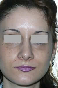 despues-rinoplastia Caso rinoplastia