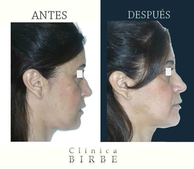 Cirugía ortognática - antes y después