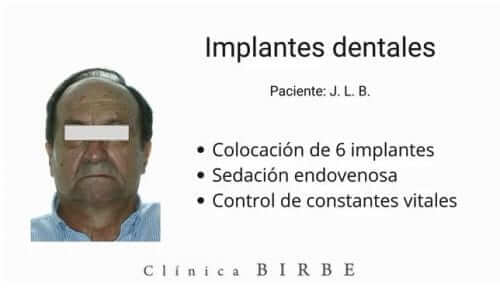 Paciente para implantes dentales