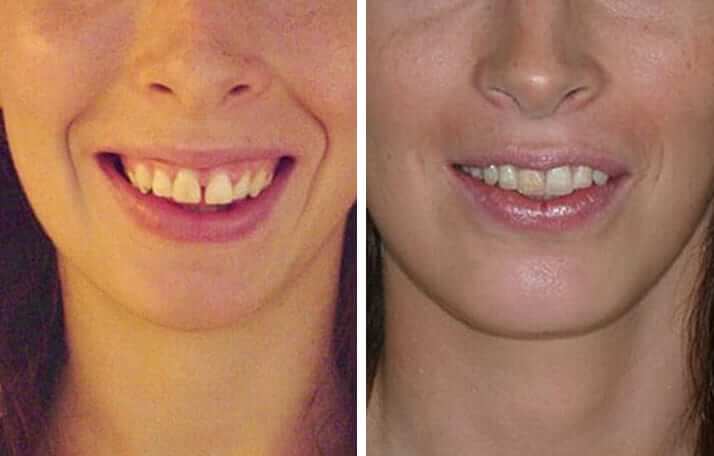 antes-despues-tratamiento-sonrisa-gingival-clinica-birbe-barcelona antes-despues-tratamiento-sonrisa-gingival-clinica-birbe-barcelona