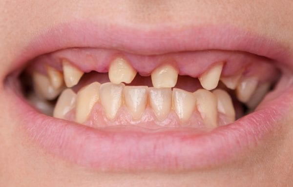 antes-implantes-dentales Implants dentals a Barcelona - Abans