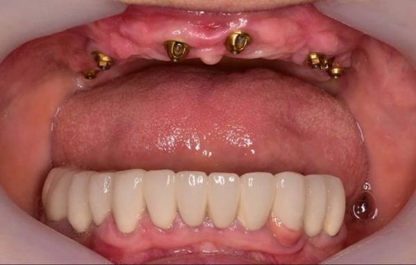antes-implantes-dentales-barcelona Pacient sense dents superiors
