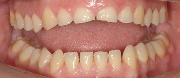 antes tratamiento Smile Design antes tratamiento Smile Design