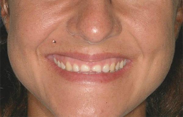 antes-tratamiento-smile-design 1 antes tratamiento Smile Design