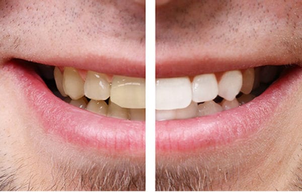 Estética dental – Blanqueamiento dental Estética dental - Blanqueamiento dental