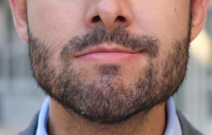 Cirugia ortognatica prognatismo mandibular Prognatismo mandibular