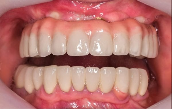 despues-implantes-dentales-barcelona Després dels implants