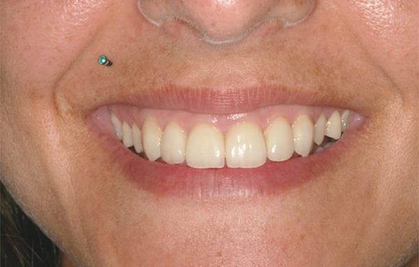despues tratamiento smile design después tratamiento Smile Design