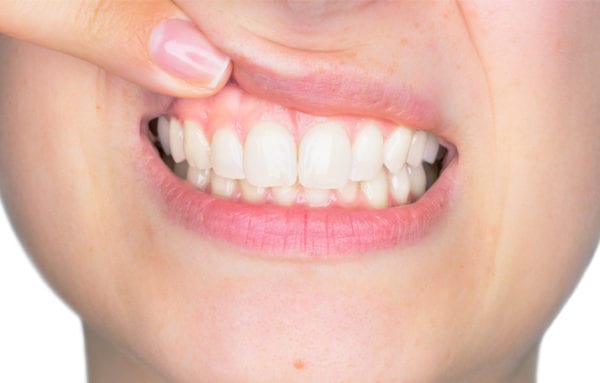 Estética dental – Gingivectomía correctiva Estética dental - Gingivectomía correctiva