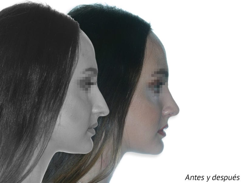 La nariz se siente obstruida después de la rinoplastia