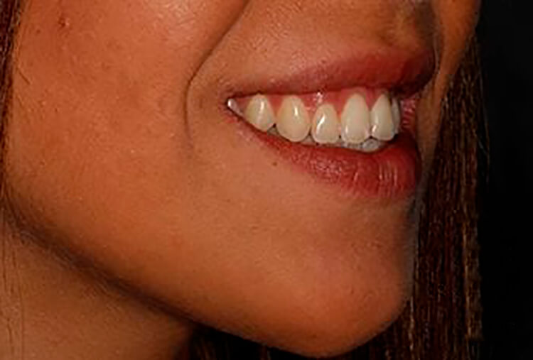 carillas-de-porcelana-antes-2